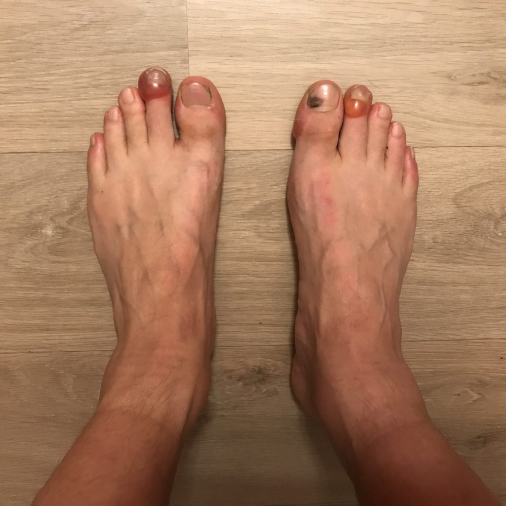 Moje nohy s puchýři na konci závodu.